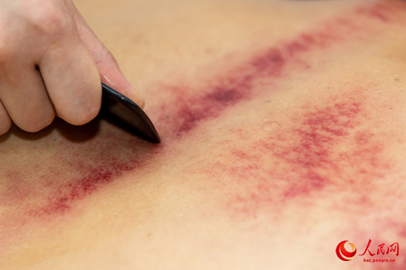 ?ытайлы? тамаша ?н?м Гуа-ша ж?не д?ст?рл? ?ытай терапиясы